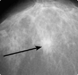 Маммограф МЭМ 20-08