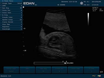 EDAN U2