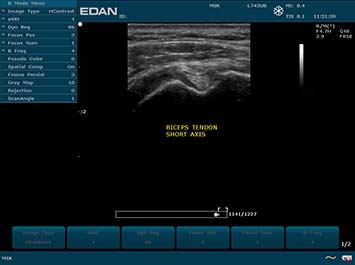 EDAN U50