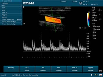 EDAN U50
