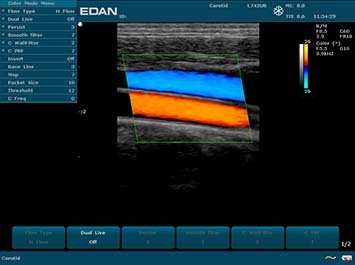EDAN U50