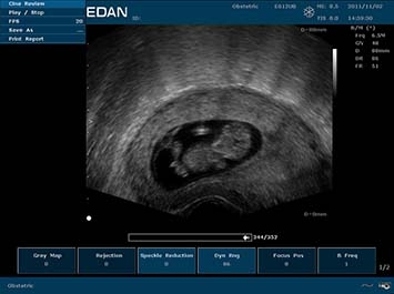 EDAN U50