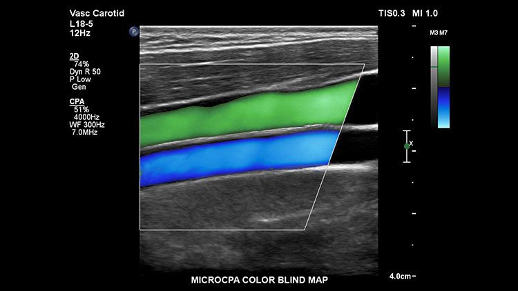 Philips EPIQ CVx