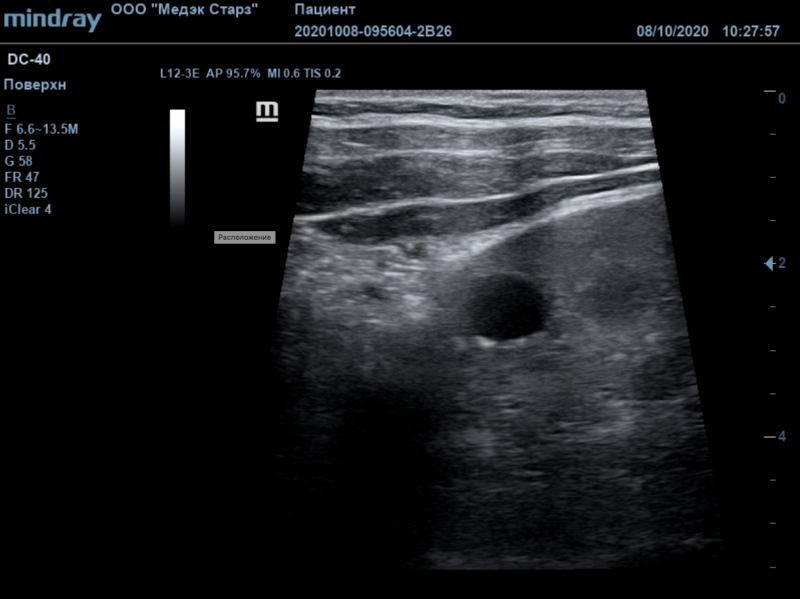 Philips EPIQ CVx